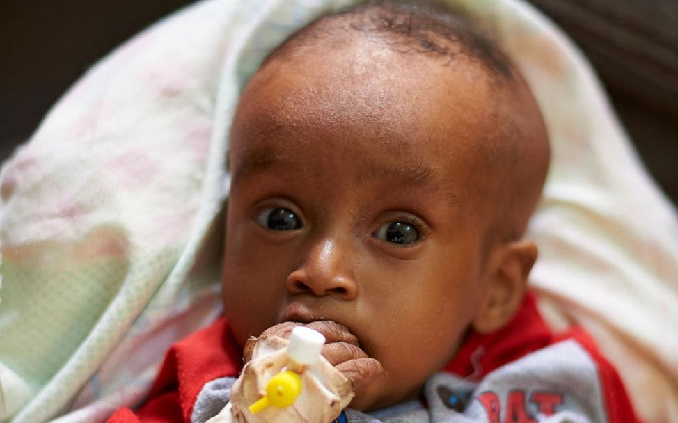 Sudan Konflikt: Erdnusspaste hilft mangelernährten Kindern – zum Beispiel diesem Baby. 