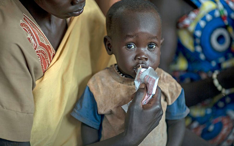 Südsudan: Abraham ist mangelernährt. Er bekommt Erdnusspaste