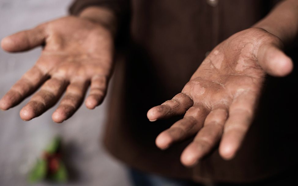 Libanon: Der 15-jährige Mohamad zeigt die Schwielen an seinen Händen.