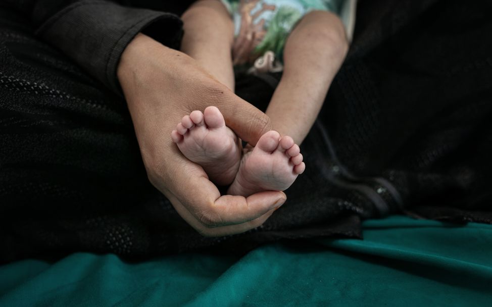 Jemen: Die 4 Monate alte Ethar Omar Abdo Alshahar im Krankenhaus von Sana'a leidet an Mangelernährung