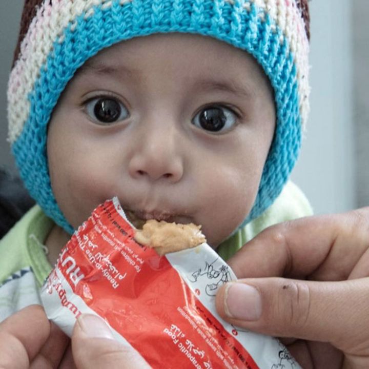 Ein mangelernährtes Kleinkind im Jemen bekommt Erdnusspaste gegen den Hunger.