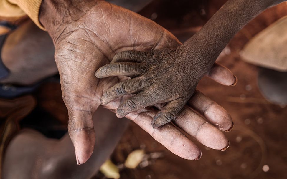 Spenden für Madagaskar: Die Hand eines unterernährten Kindes auf der Hand eines Erwachsenen. 
