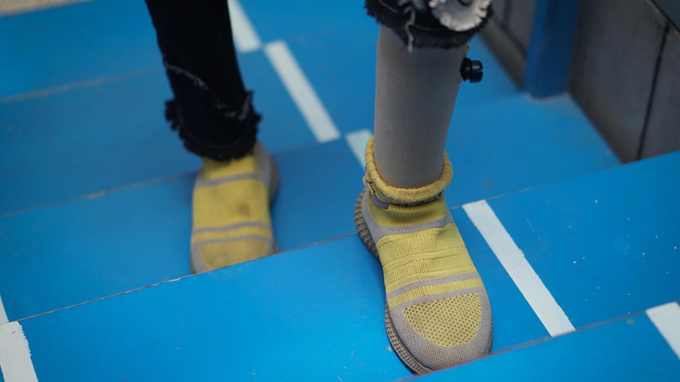 Jemen: Ayah übt, mit ihrer Beinprothese Treppen zu steigen
