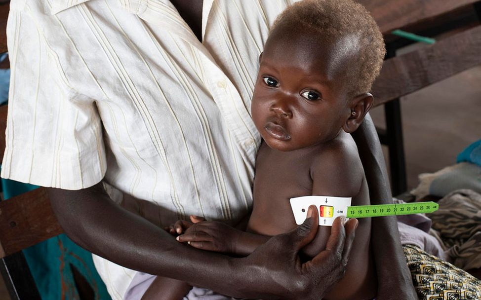 Corona in Afrika: Bei einem Kind wird der Armumfang gemessen. Es ist mangelernährt