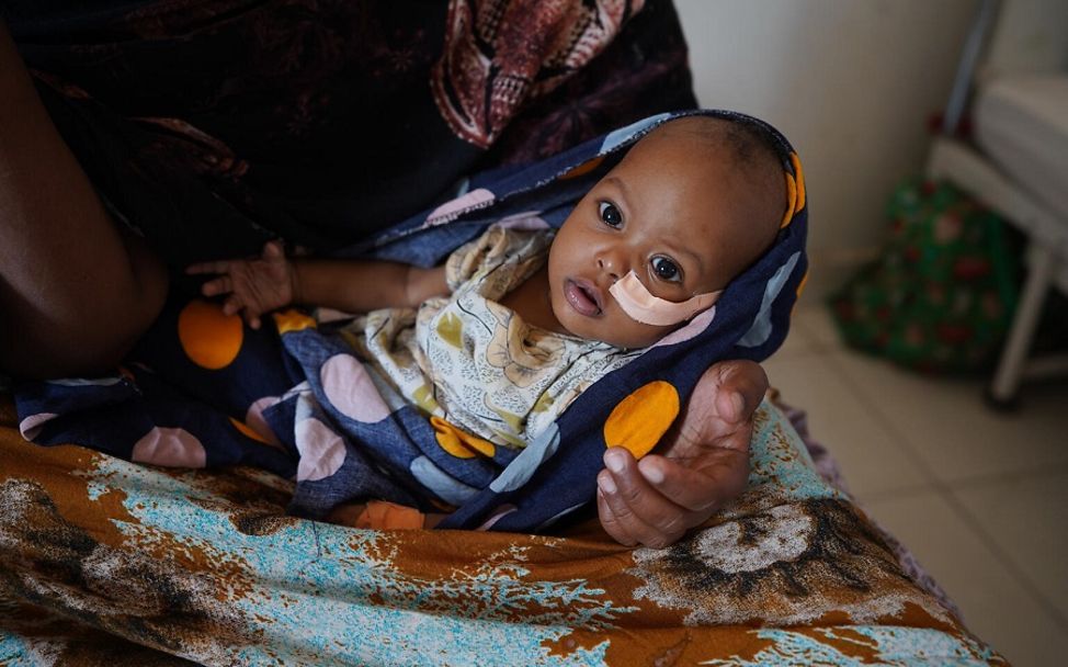 Somalia: Baby bekommt über eine Sonde Nahrung.