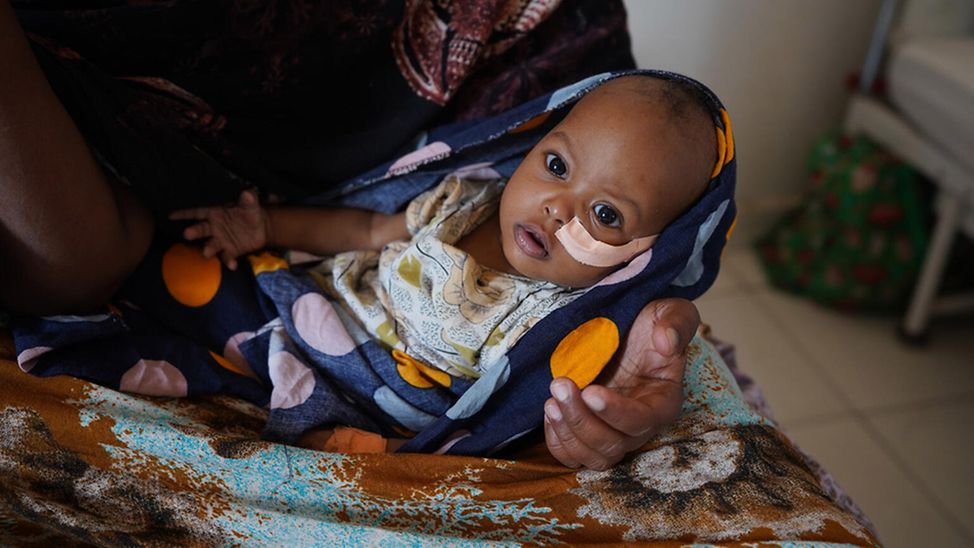 klimawandel folgen kinder: Baby Sukra aus Somalia leidet an Mangelernährung.