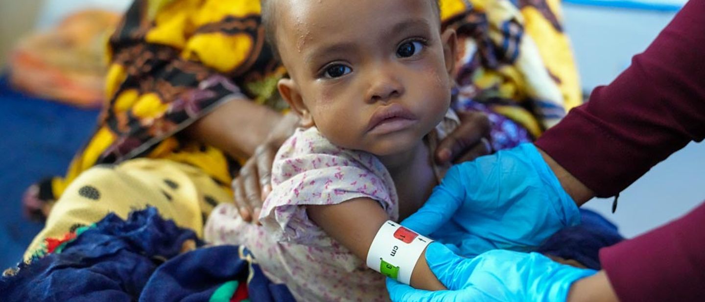 Somalia spenden gegen drohende Hungersnot: Ein unterernährtes somalisches Kind wird untersucht.  