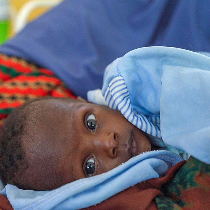 Drohende Hungersnot Somalia: Dieses unterernährte Kleinkind in Somalia konnte mit Spezialnahrung gerettet werden.
