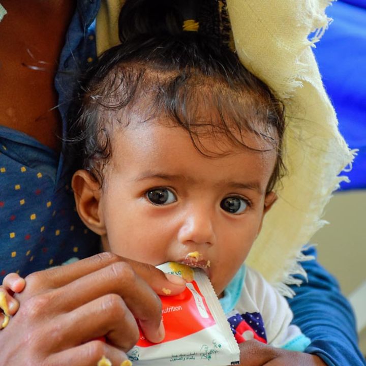 Jemen Nothilfe: Ein mangelernährtes Baby wird mit Spezialnahrung gegen den Hunger gefüttert.